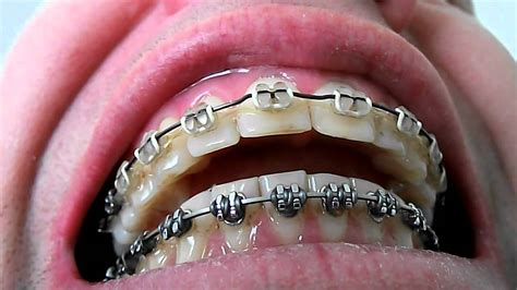 doe all metal braces brackets need wire|finishing wire for braces.